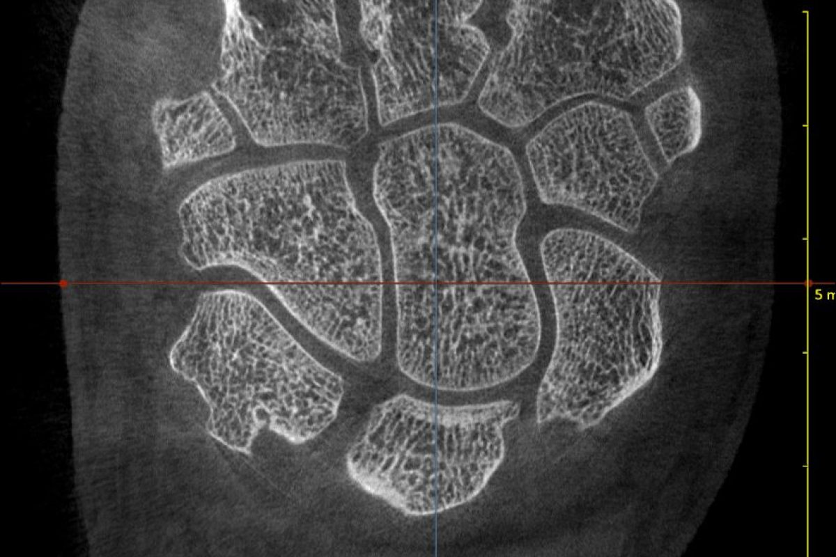 WRIST COR 2